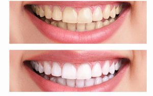 Современные методы отбеливания зубов в условиях клиники